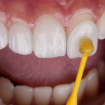 The Complete Guide to Porcelain Veneers in Agoura Hills